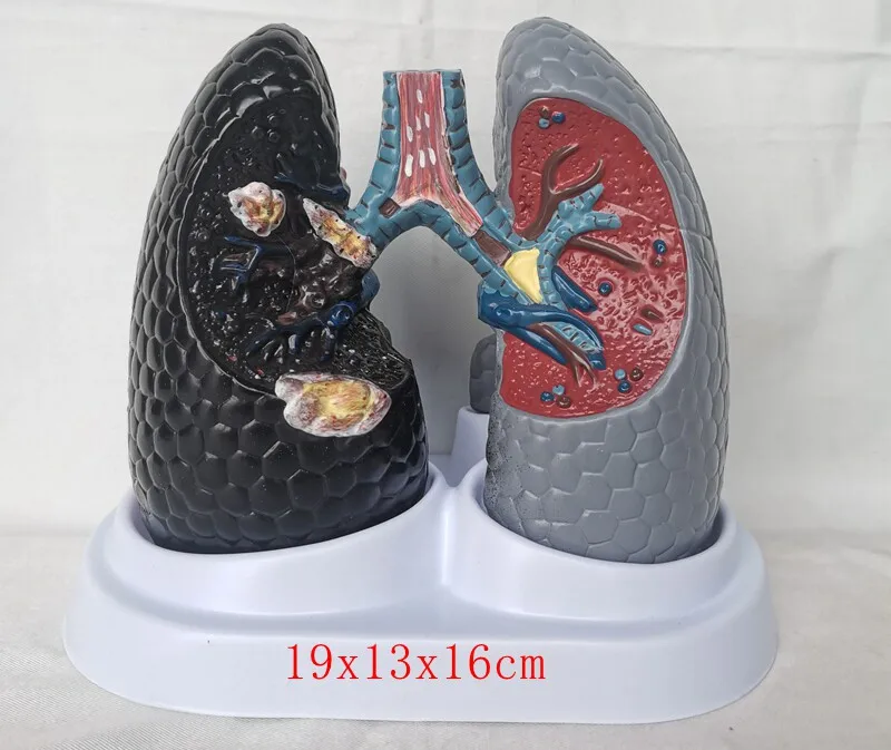 Smoking Cancerous Lung Model vs Healthy Lung Model Human Organ Anatomical Model Tobacco Hazards Teaching Demonstration Model
