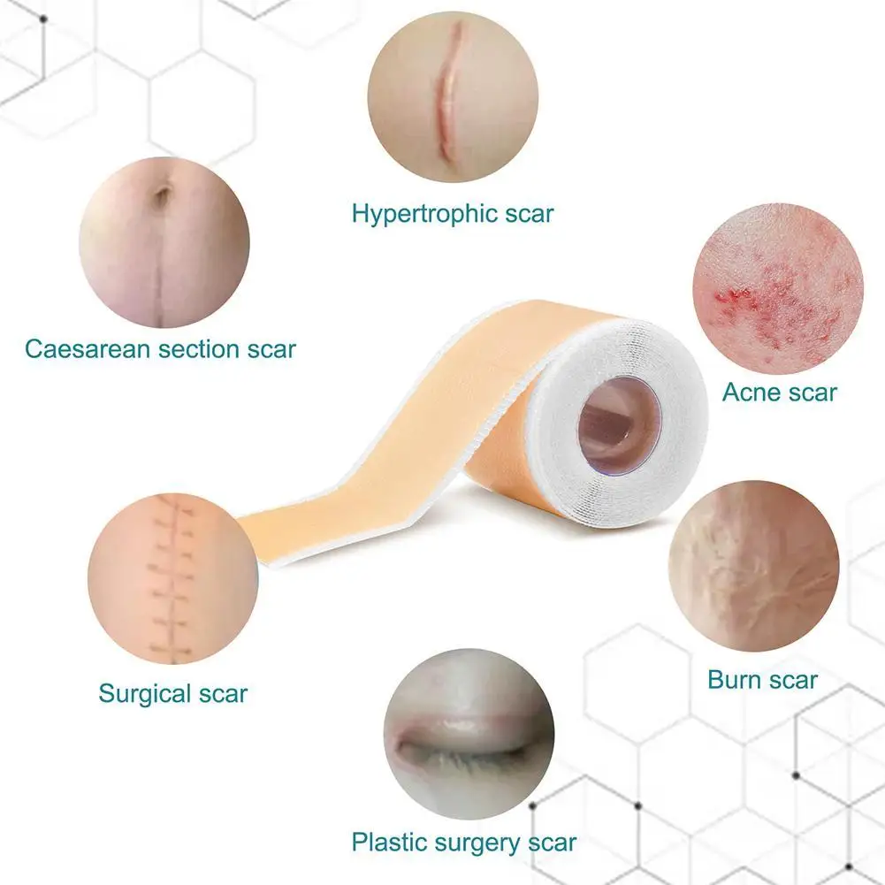 Rouleau de ruban adhésif en silicone indolore, pâte à cicatrices, efficace pour la section C, proporchéloïdes, outils de réparation des cicatrices d'acné brûlées, beauté de la peau, 4x1.5m