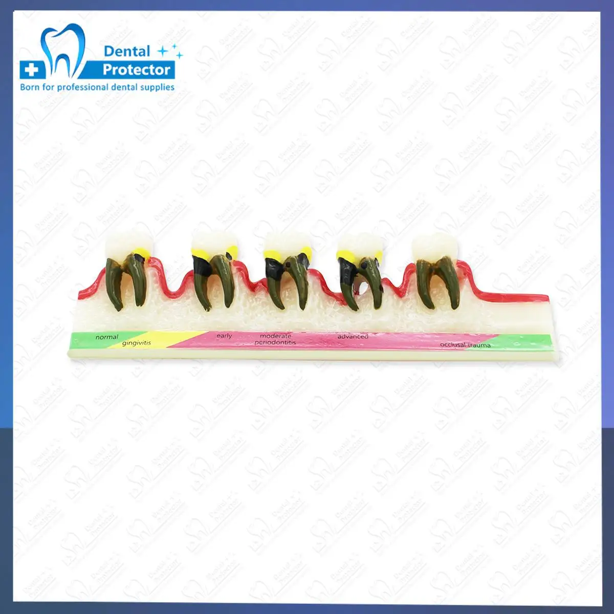 Dental Model Disease Tooth Model Tooth Dental Teaching Model for Dentist Teaching Training Learning Doctor-patient Communication