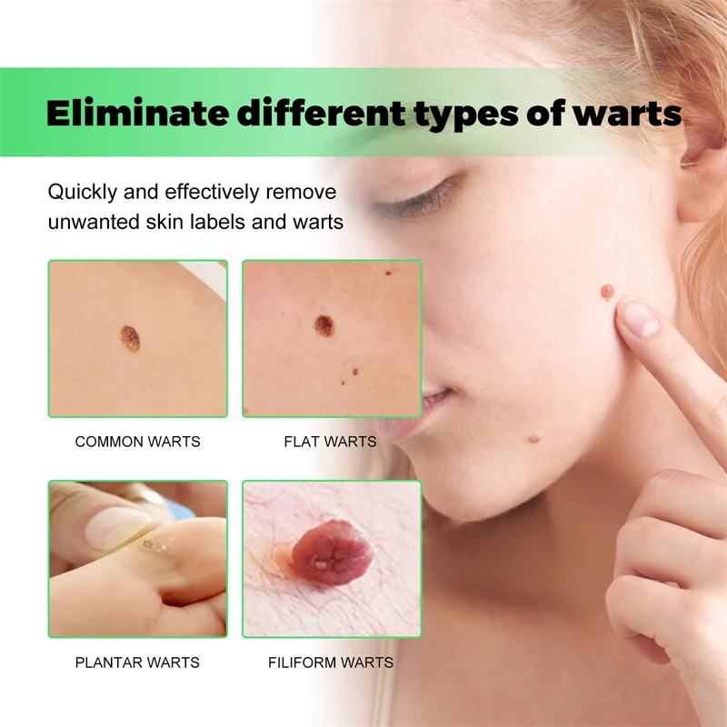 Ke Wart Regina pour remodelage du visage et du cou, Nevus, Chair, Silky Wart Body Books