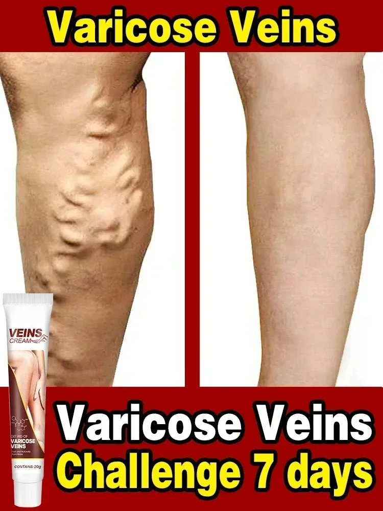 Varicose Vein Relief Paste Improve Blood Circulations Spider Varicose Vein For Tired Heavy Legs Fast Relief New