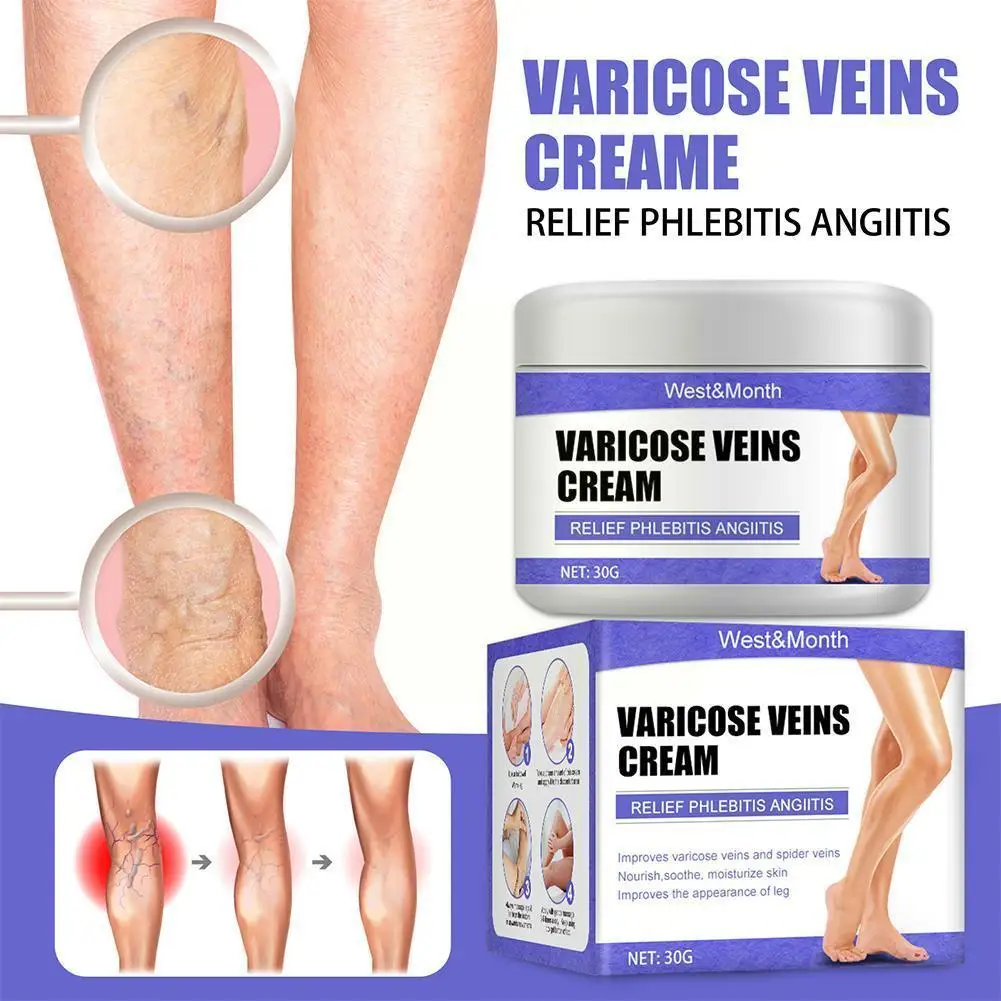 Efficace crema per il sollievo delle vene Varicose alleviare la vasculite 30g unguento per cure mediche trattamento per la flebite del ragno del corpo cerotto U7d5