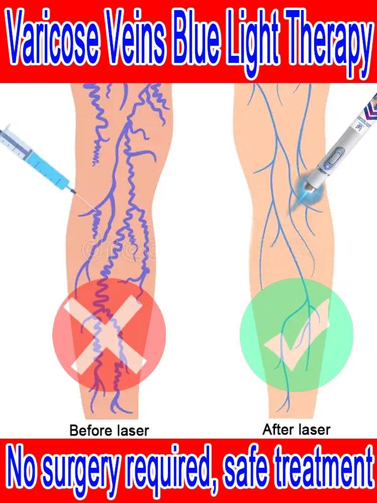 

New Varicose Vein Laser Eliminates Vasculitis and Phlebitis, Relieves Spider Leg Pain, Laser Pen Therapy
