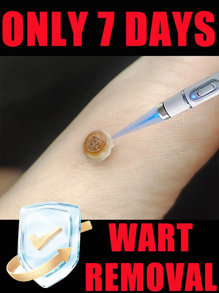 ᴸᵃˢᵉʳ ᵖᵉⁿ ᵃᶜᶜᵘʳᵃᵗᵉˡʸ ʳᵉᵐᵒᵛᵉˢ warts without scarring or recurrence