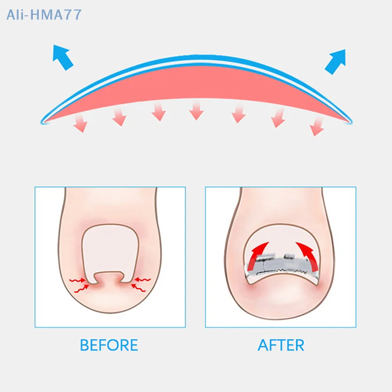 Ingrown Toenail Corrector Tools Pedicure Recover Embed Toe Nail Treatment Professional Ingrown Toenail Correction Foot Care Tool