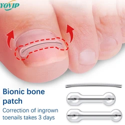 1Pair Ingrown Toenail Correction Tool Ingrown Toe Nail Treatment Elastic Patch Sticker Straightening Clip Brace Pedicure Tool