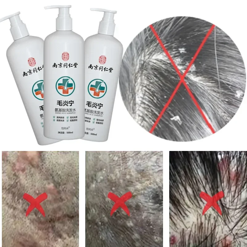 Shampoo Repair Hair Follicle Plant Mite Removal Hair Cream Antidandruff and Antipruritic Damage Repair Improve Frizz Шампунь