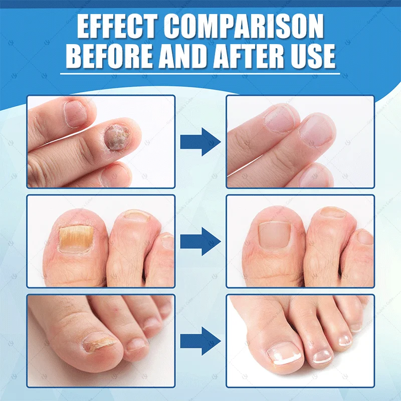 เล็บเลเซอร์สีน้ำเงิน