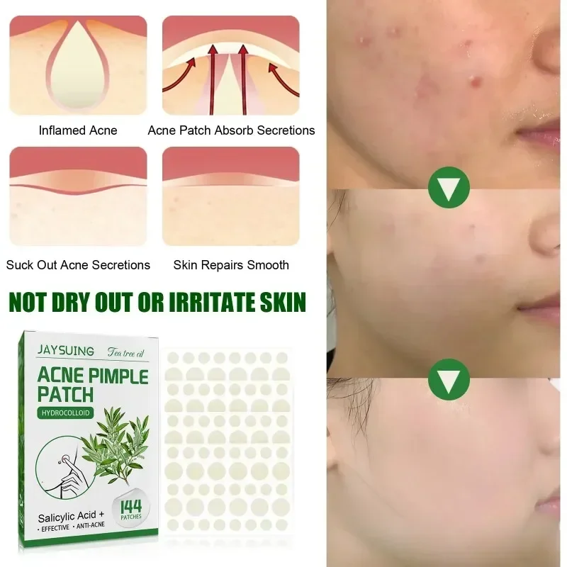 144pcs Acne Pimple Patch Face Invisible Stickers Quick Effect Treatment Removing Patches Beauty Acne Tools Face Skin Care