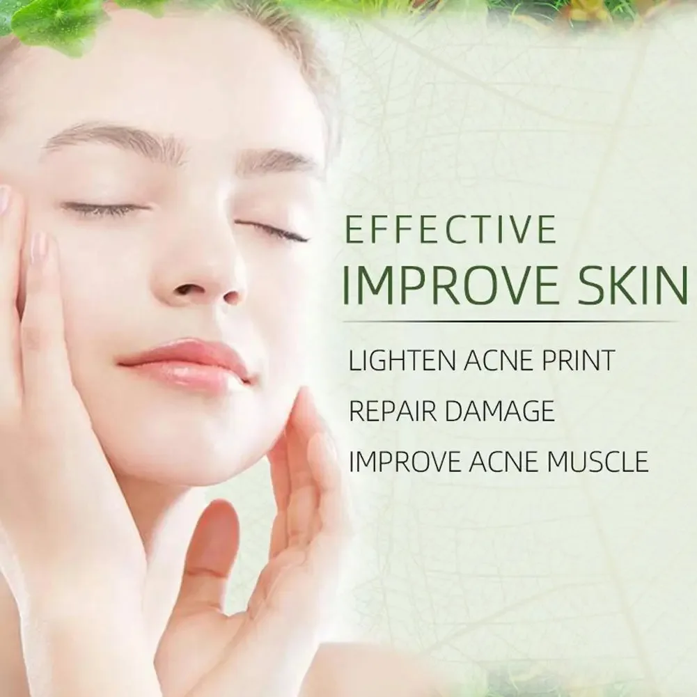 JoyPrettyin كريم وجه حب الشباب العشبي إزالة علامات البثور السيطرة على النفط ترطيب Pockmark كريمات الوجه الناعمة منتج العناية بالبشرة