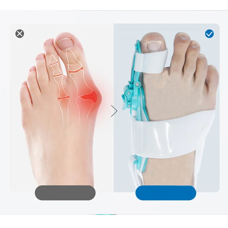 New Hallux Valgus Corrector Bunions For Toes Corrector Foot Finger Separator Toe Separator Foot Care Haluksy Bunion Corrector