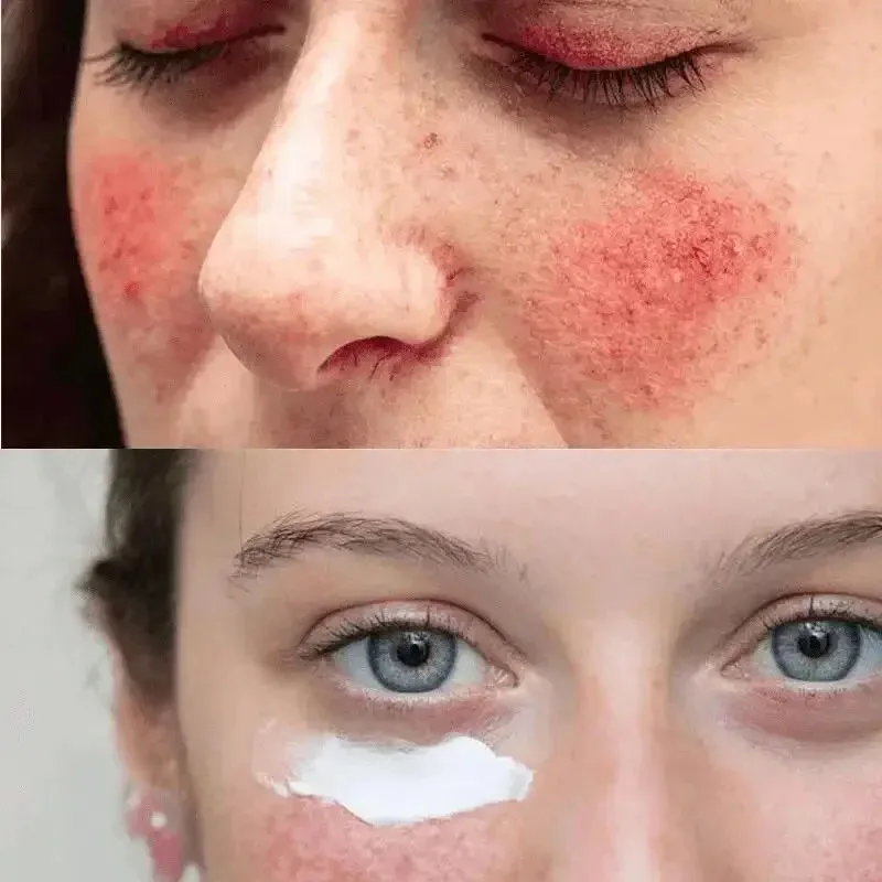 Krim Perbaikan pemerah wajah yang efektif perawatan jerawat merah muda Rosacea menenangkan meningkatkan kelembapan sensitif mencerahkan perawatan kulit