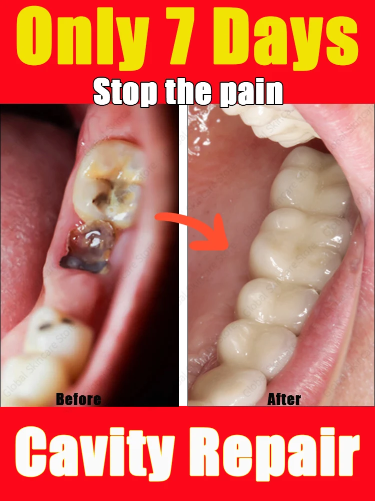 Resuelve el problema de caries y decay de dientes.