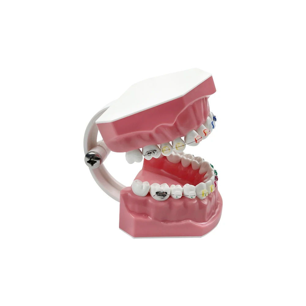 Half Metaal Half Keramisch Tandheelkundig Orthodontisch Gebit Model Met Beugel Standaard Tandheelkundig Onderwijsmodel Voor Het Bestuderen Van Onderwijs