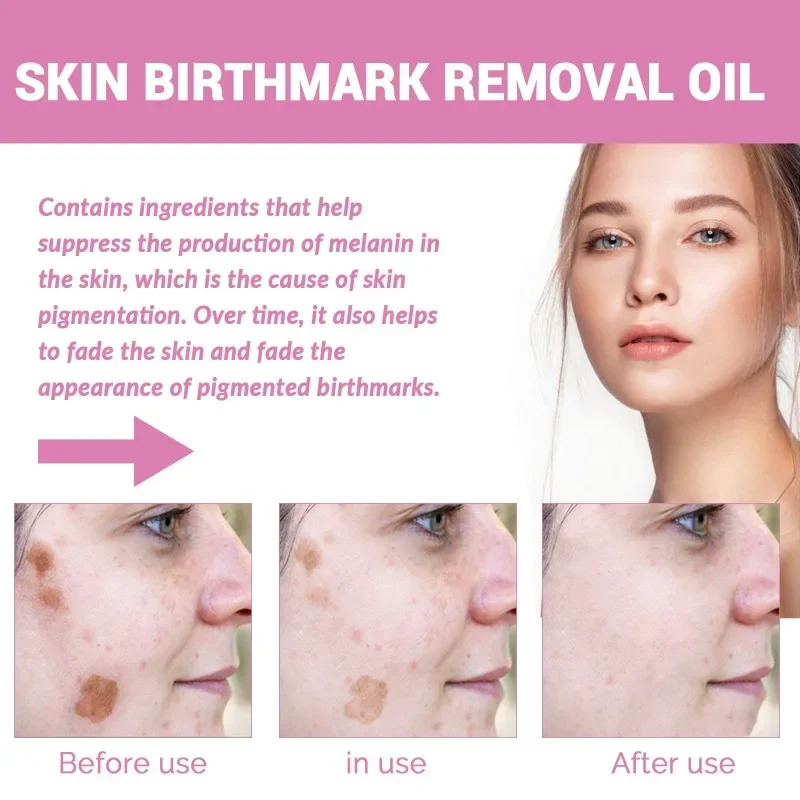 Skin Birthmark removal Serum Anti Freckle fade Pigmentation Melasma Moisturizing Whitening Brighten Face  Care Essence Oil