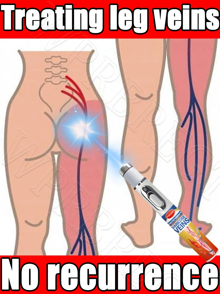 Laser pointer, varicose vein treatment