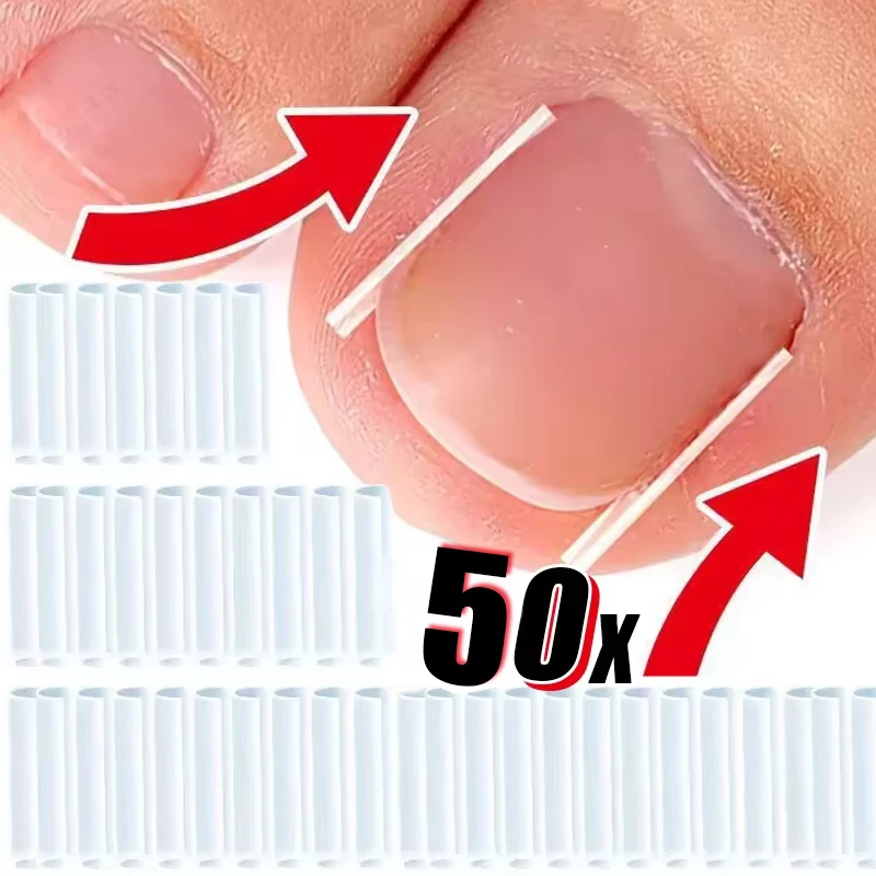 50Pcs Ingrown Toenail Correction Tool Invisible Ingrown Toe Nail Treatment Pad Groove Straightening Clip Brace Foot Care Tool
