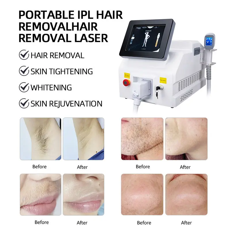Macchina per la depilazione laser a diodi per apparecchiature di bellezza laser di nuovo design 808