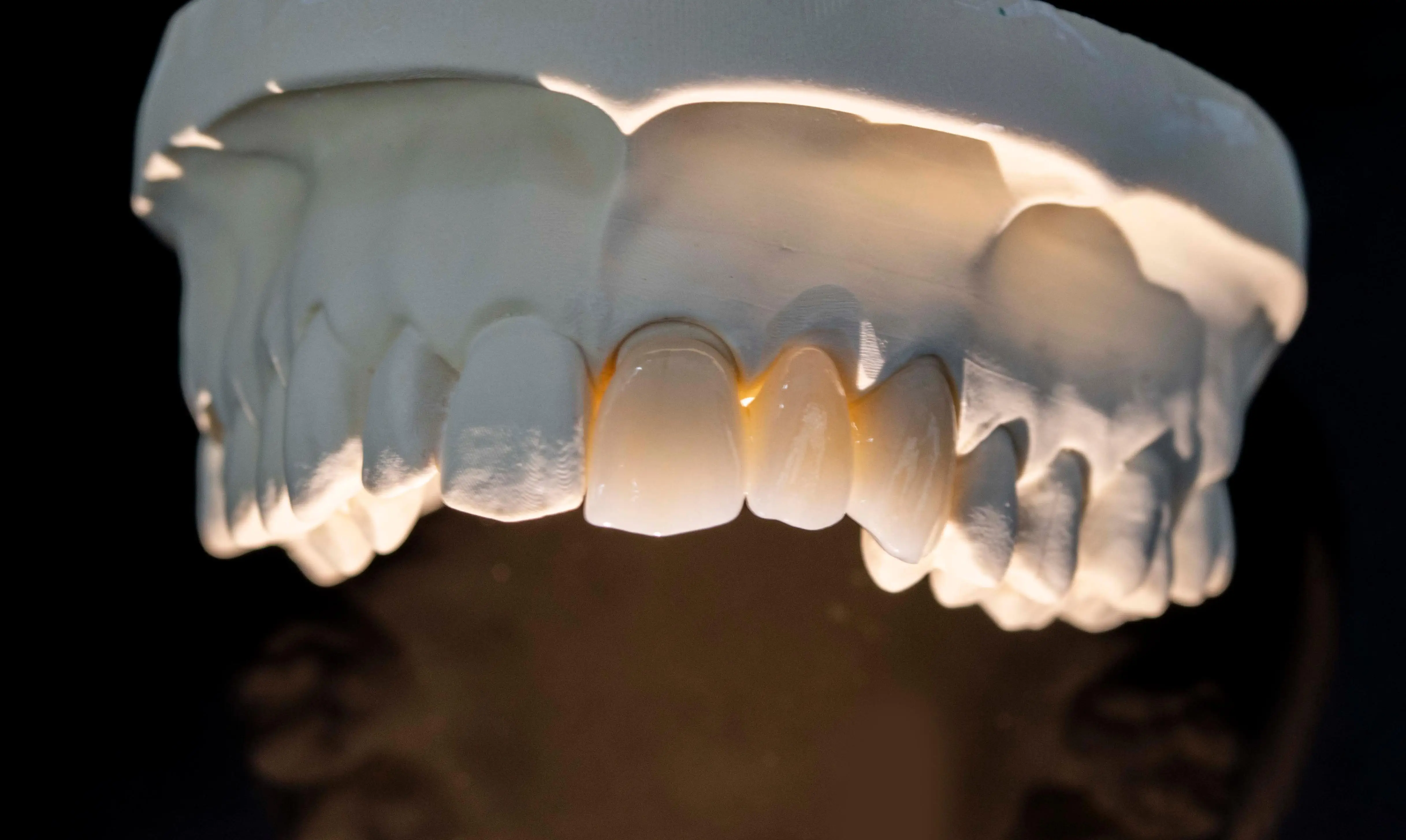 HT Lithium Disilicate Blocks Glass Ceramic for CAD CAM Inlab System ( 5 Pcs )