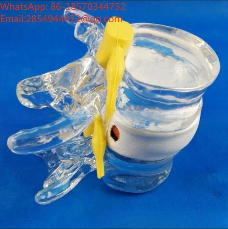 demonstration-model-of-human-lumbar-intervertebral-disc-compression-spine-pathological-prolapse-of-spine