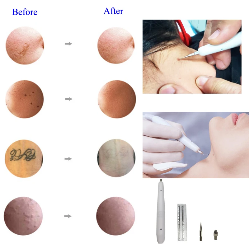 مزيل الثآليل المحمول لإزالة علامات الجلد من أورو، آلة إزالة الشامات عالية التردد #6