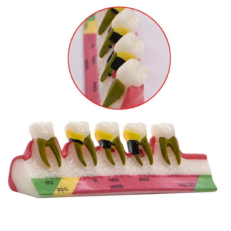 Dental Periodontal Disease Model 5 Stages Perio Disease Assort Demo Caries Periodontitis Dentistry Teaching Training Teeth Model