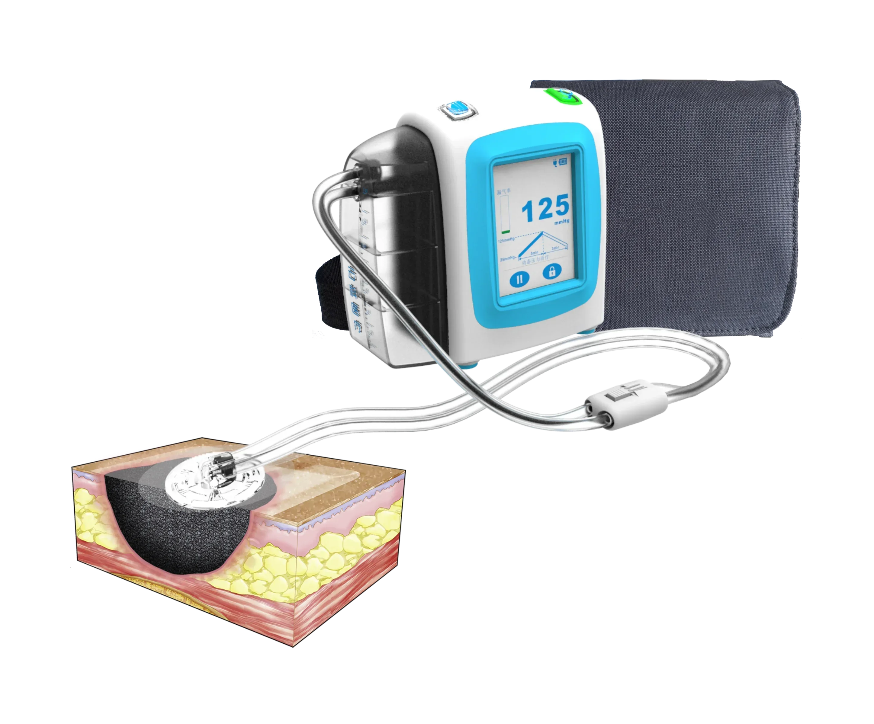 negative pressure wound therapy machine with drainage canister 140ml/450ml & 10sets different size NPWT medical dressing kit image 2