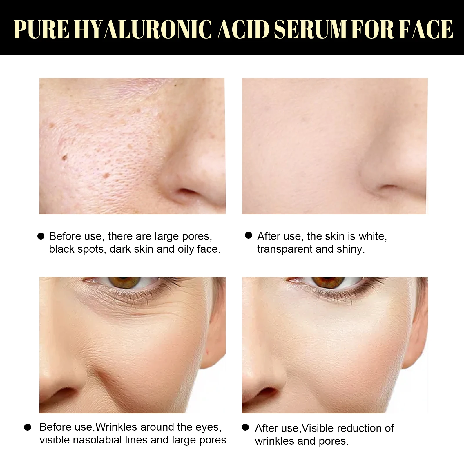 コラーゲン糸 フェイスリフト 肌の引き締め 若返り 小じわの改善 顔の栄養補給 深層修復 肌の引き締め プロテインライン