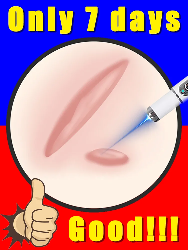 blauw licht pen los litteken op, gratis verzending, littekenverzorgingstools, unisex