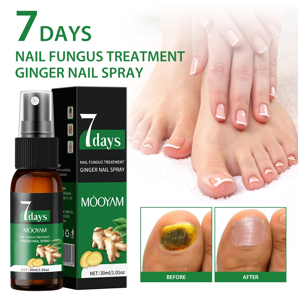 Sérum de traitement des champignons des ongles, 7 jours, élimination des champignons des orteils, Essence Anti-Infection, Onychomycose, Paronychia, produits de soins des ongles