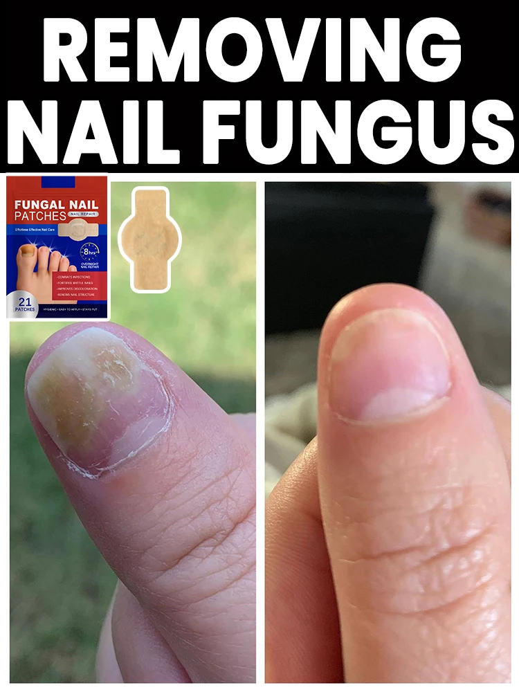 21 pieces of onychomycosis stickers waterproof nail repair stickers nail ingrown nail correction stickers foot care tools