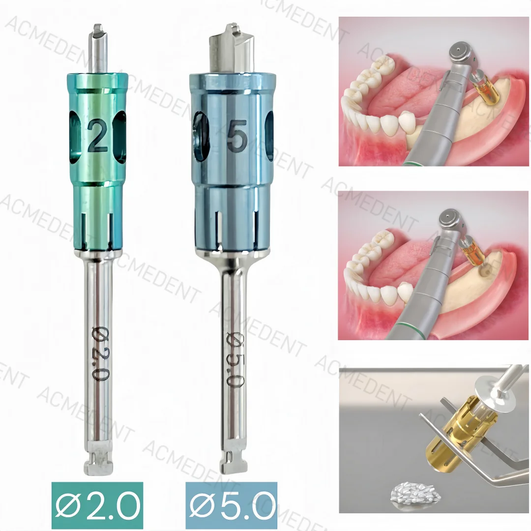 2Sizes Dental Never Loss AutoBone Collector Drill Implant Stopper Self Bone Power Gain Autobone Chip Maker NLB GBR ∅2.0/∅5.0