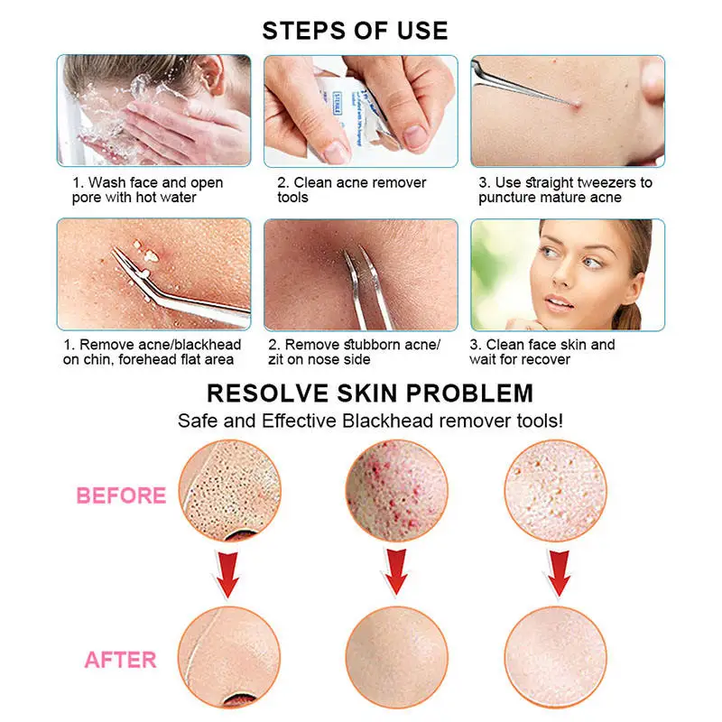 3 قطع ملاقط الرؤوس السوداء الاحترافية للعناية بالجمال من الفولاذ المقاوم للصدأ أدوات إزالة حب الشباب #5