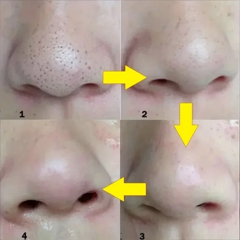 Bandes pour points noirs et nez, 10 à 100 pièces, nettoyage en profondeur des taches nasales, autocollants pour points du visage, masque nasal, Shill pour l'acné et la tête noire, livraison directe