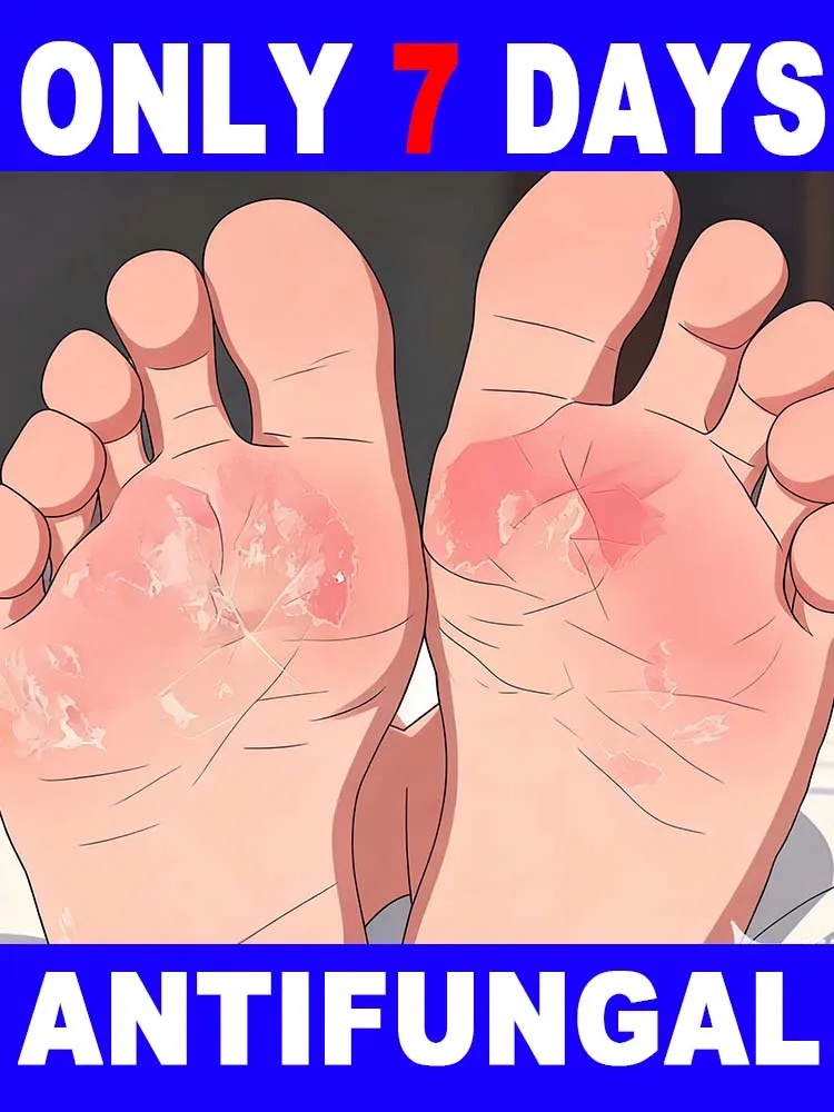 Hot selling Hᴇᴀʟɪɴɢ Fᴏᴏᴛ Uʟᴄᴇʀs, Tɪɴᴇᴀ Pᴇᴅɪs, Aɴᴅ Fᴜɴɢᴀʟ Iɴғᴇᴄᴛɪᴏɴs Oғ Tʜᴇ Fᴇᴇᴛ #1