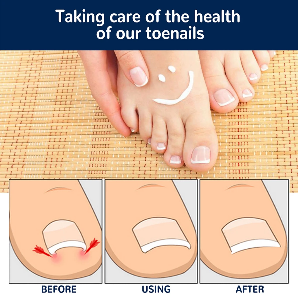 첫 번째 무접착제 패치, 손톱 손발톱 유물, 특수 교정, 점차적인 교정