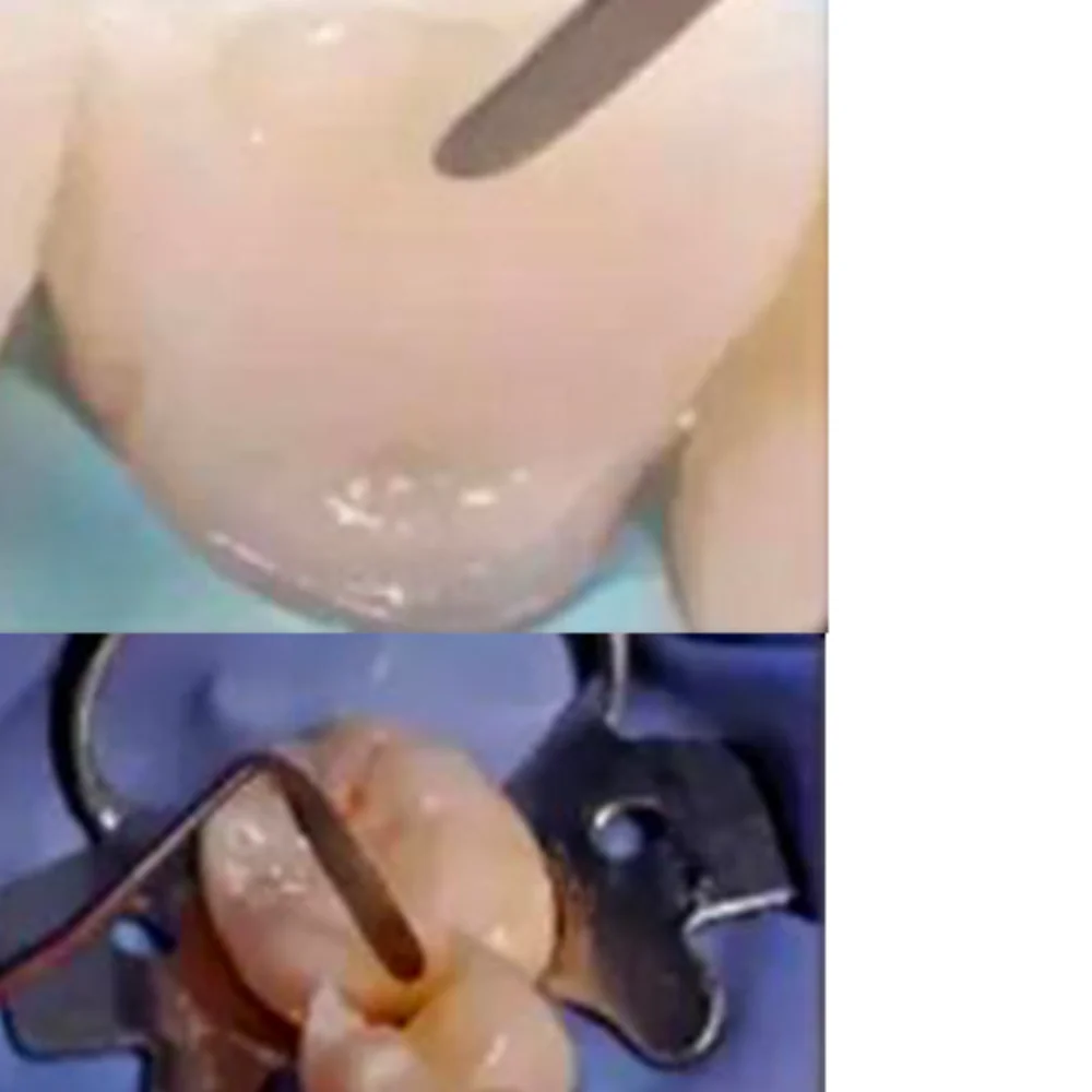 ملعقة راتينج الأسنان لحشو السيليكون المركب أداة ترميم جمالية أداة طبيب الأسنان 1 قطعة #1