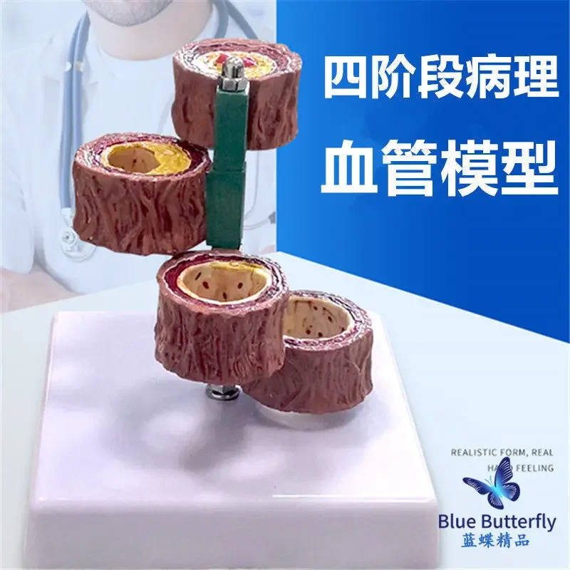 Blockage Of Blood Vessels, Blood Concentration, Fat Pathology, Blood, Human Vascular Pathology, Anatomical Model