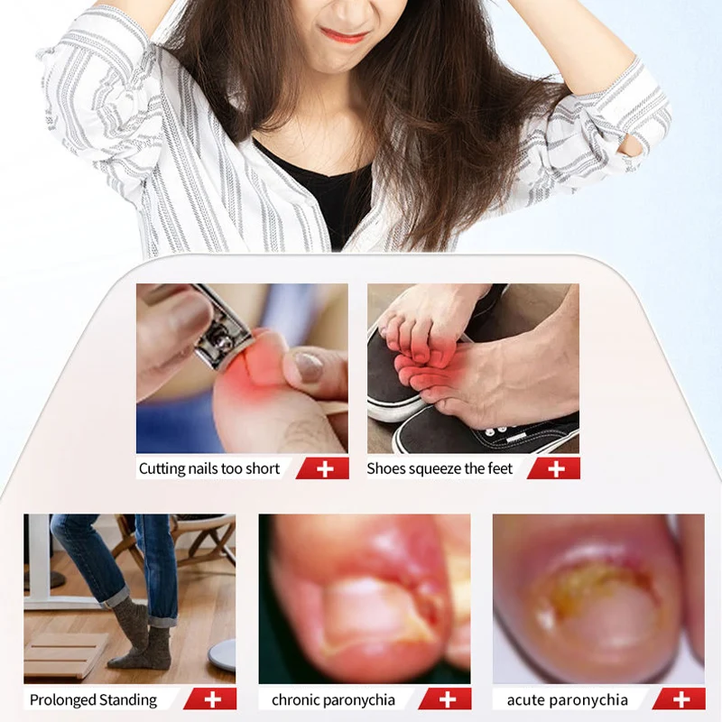 Jiyatengnai نوع الأخدود للأظافر محلول الرعاية الصحية الخارجية يهدئ أظافر القدم الغامضة والانتفاخ والازعاج حل مسحة الرعاية الخارجية