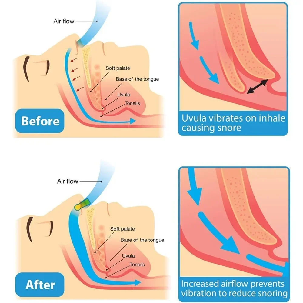 10-30 قطعة جهاز إيقاف الشخير TPR مشبك أنف مرن لوازم مكافحة الشخير لمنع الشخير نوم جيد سهل التنفس مشبك الأنف