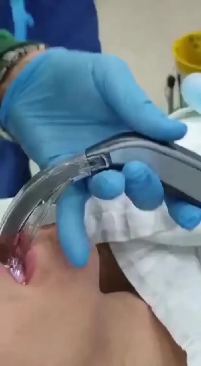 Reusable Anesthesia Video Laryngoscope  for Easier Intubation Surgery Medical Equipment