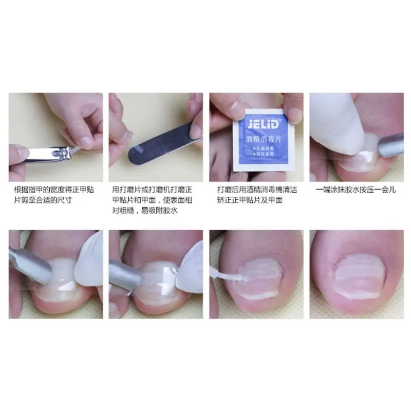 10 ชิ้นคุด Toenails ยืดเทปโค้งคลิปรั้ง Patch เล็บ Dropship