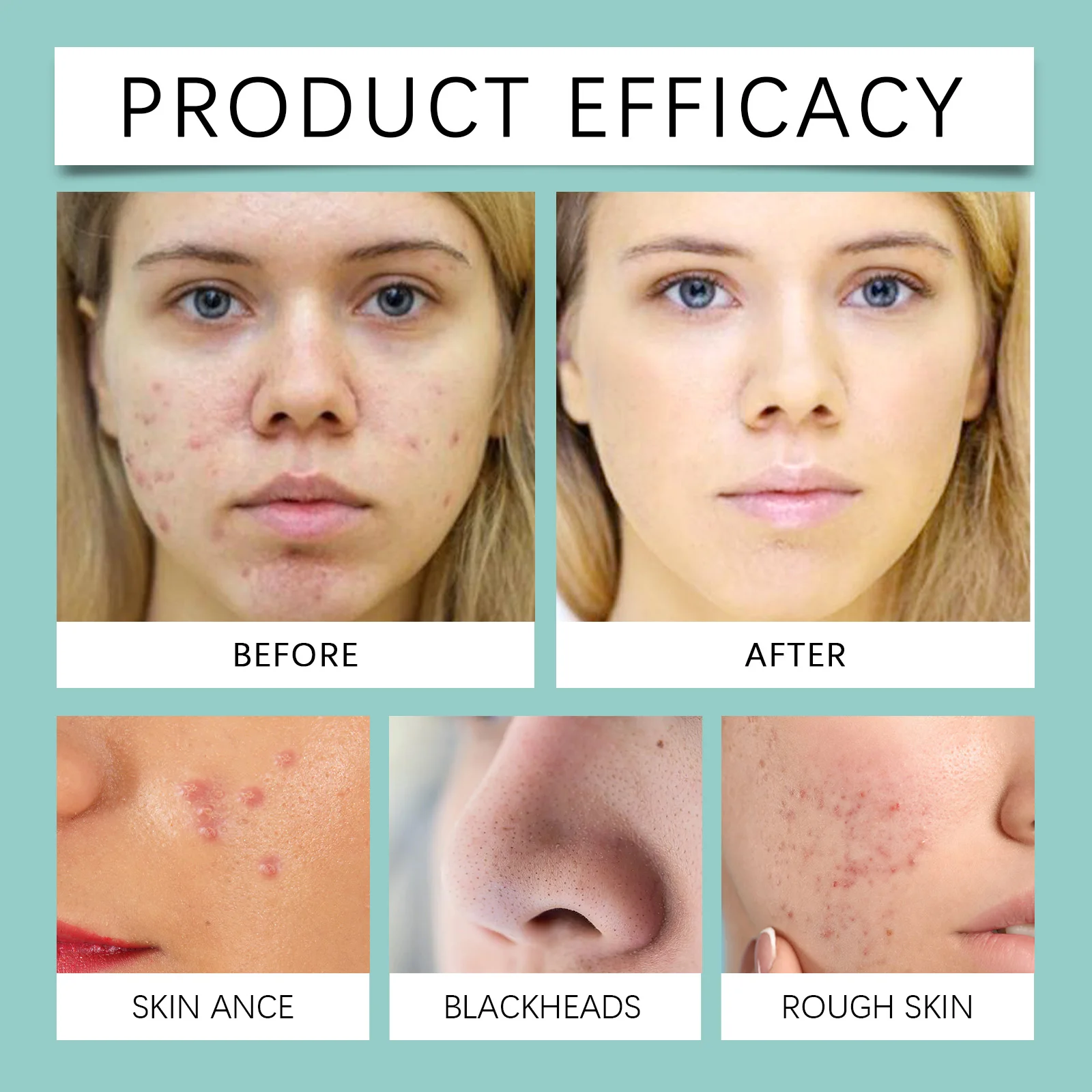 Acne Repair Facial Serum Lighten Dark Spots Face Brightening Niacinamide Licorice Root Extract Serum Skin Care Products