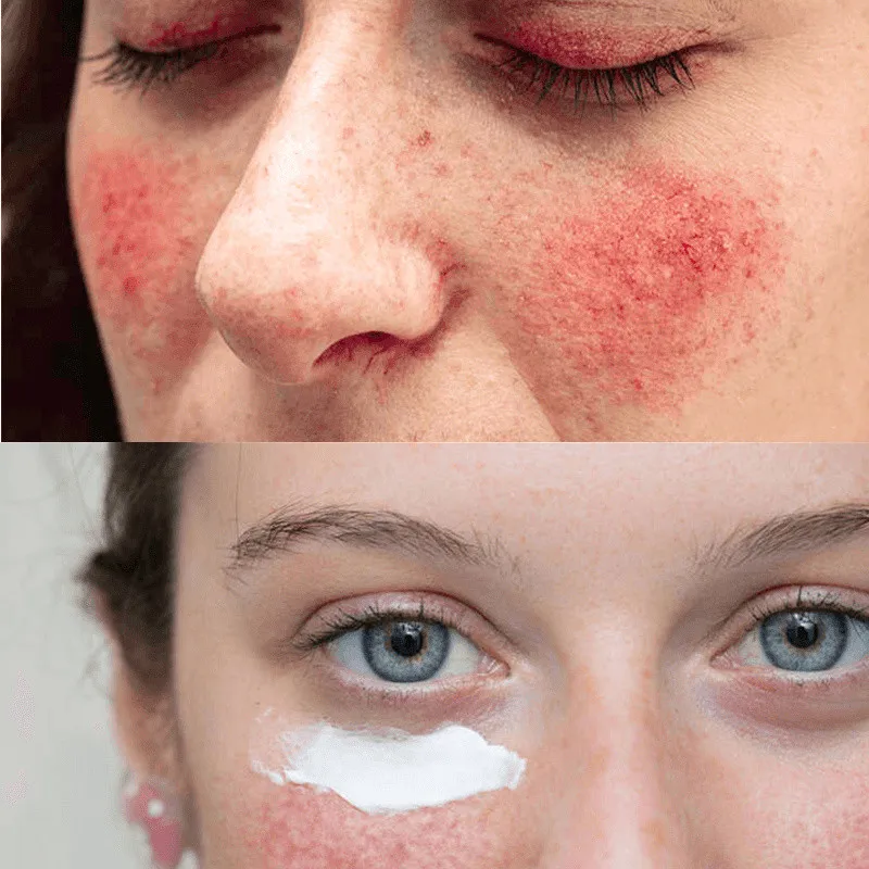 Efficiente riparazione di 7 giorni crema di arrossamento del viso pelle sensibile succhietto Anti naso rosso Acne punti neri brufoli restringere i pori pelle più chiara