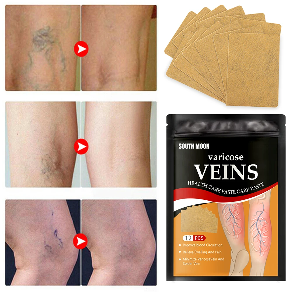 

12pcs/box Vein Health Patch Natural Herbs Cold Compresses Relieve Varicose Legs Blocked Blood Vessels for Vasculitis Varicose