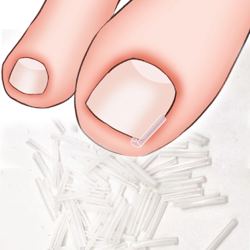 50Pcs/Box Ingrown Toenail Correction Strips Paronychia Correction Straightening Brace Toe Nail Treatment Groove Pedicure Tools