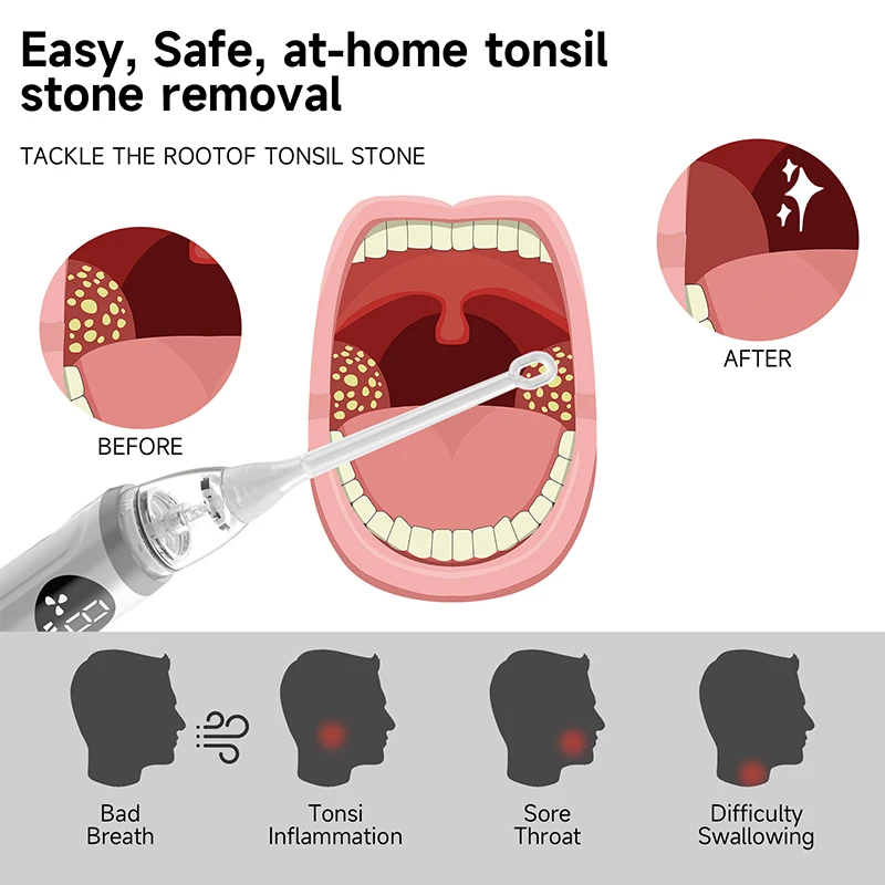 Elektryczny odkurzacz do usuwania kamieni migdałkowych Zestaw do usuwania kamieni migdałowych z strzykawką do nawadniania Natychmiastowe odsysanie