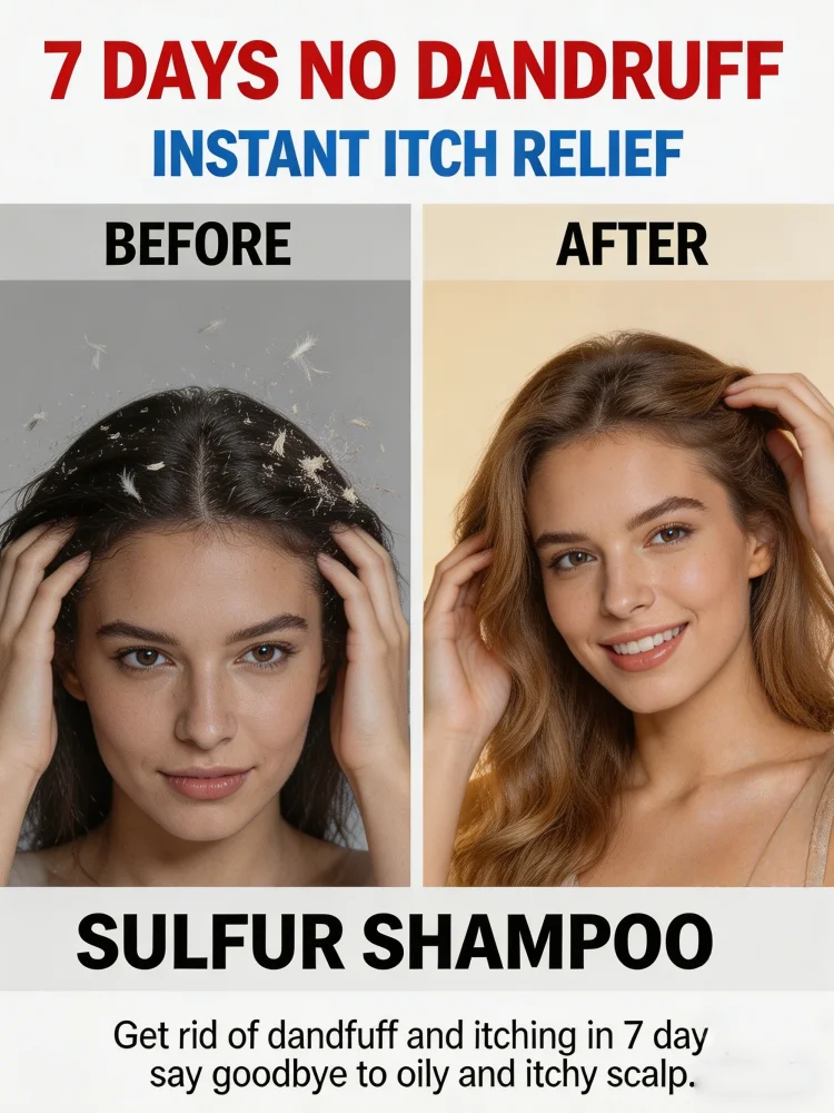 

Sulfur Shampoo for Stubborn Dandruff Recurrent Scalp Itch Relief