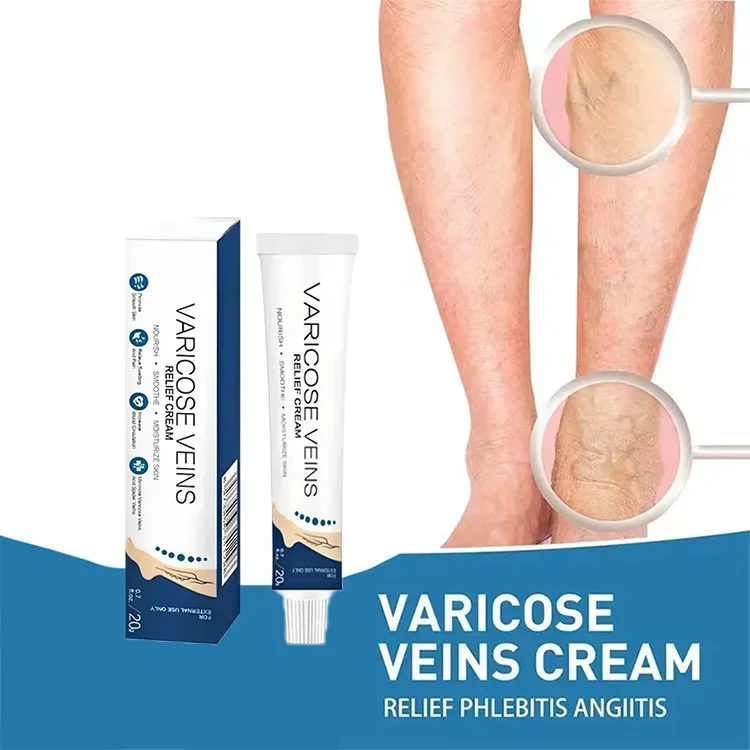 ¦¦¦¦¦¦Varicose Veins Effective Relief Of Dilated Vasculitis In The Legs Phlebitis Improved Blood Circulation