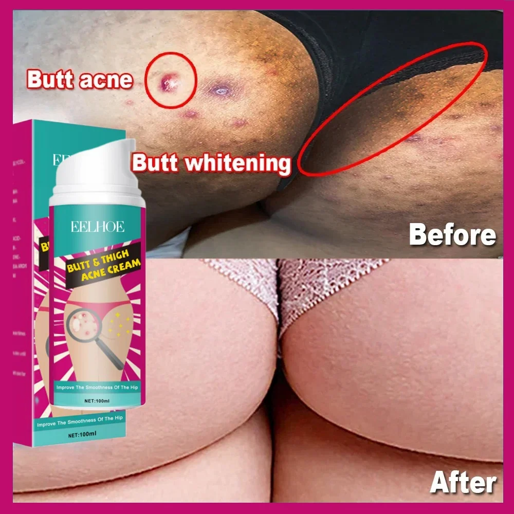 Butt Thigh Acne Clearing Spot Treatment Cream Whitening Clears Pimples Zits Razor Bumps Buttock Pores Clogging Body Lotion